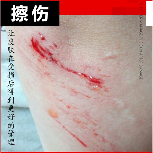 擦伤