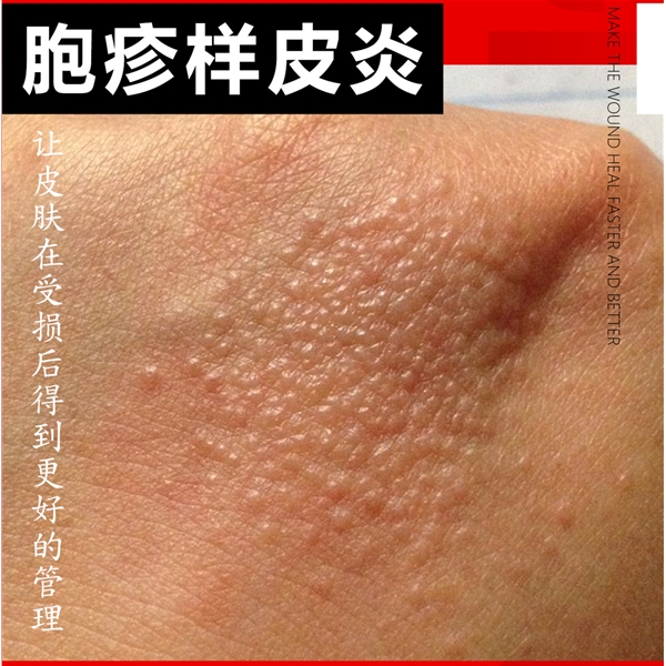 神经性皮炎