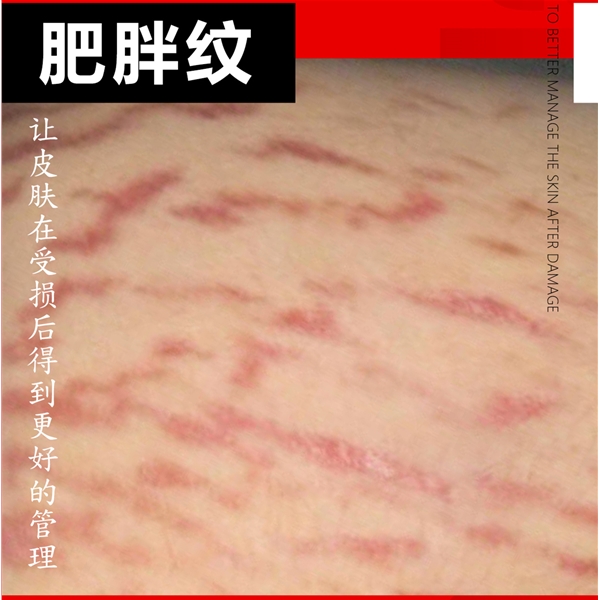 肥胖纹