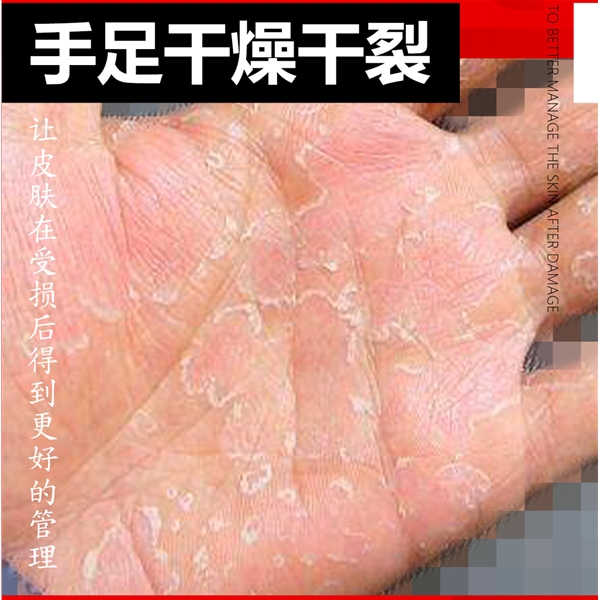 手足干燥干裂