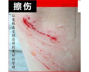 擦伤