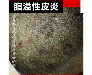 溢脂性皮炎