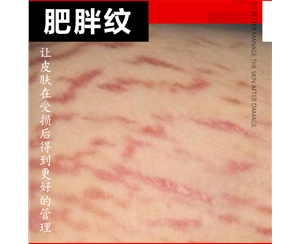 肥胖纹