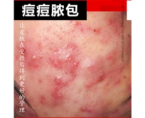 痘痘脓包