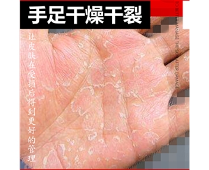 手足干燥干裂